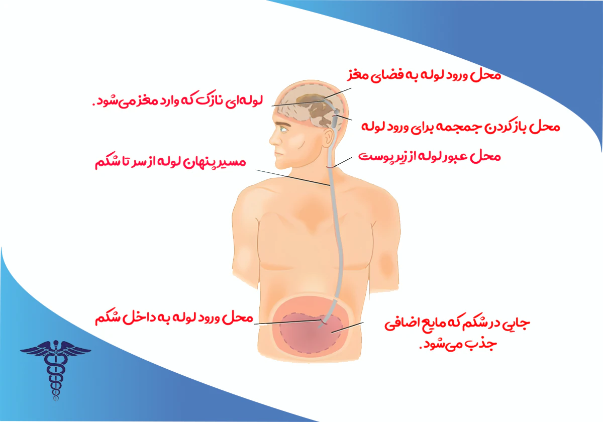 شنت گذاری برای درمان آب مغز
