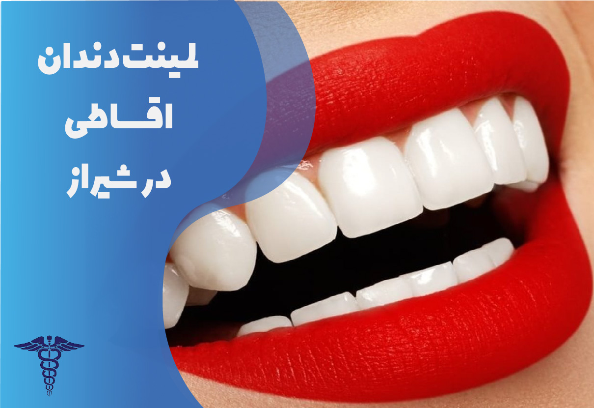 لمینت دندان اقساطی در شیراز