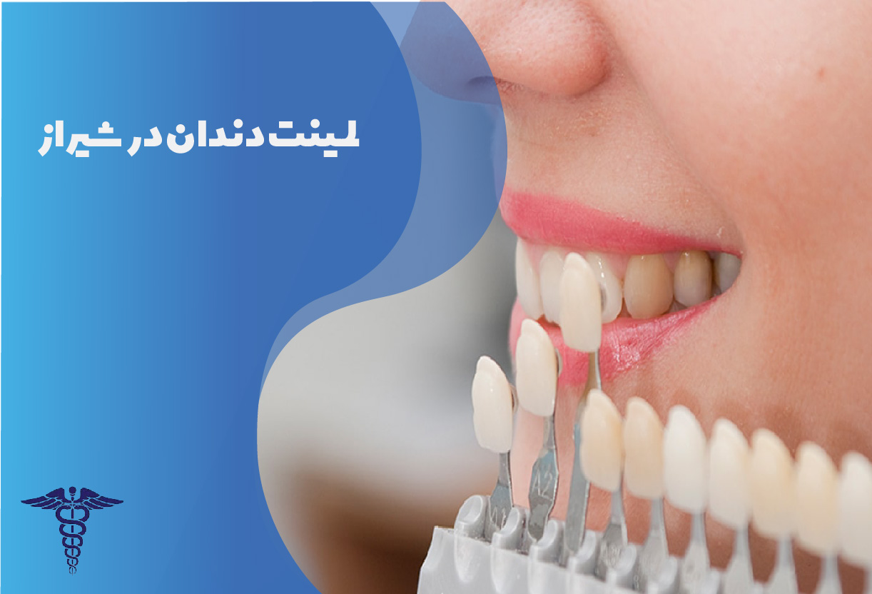 لمینت دندان در شیراز