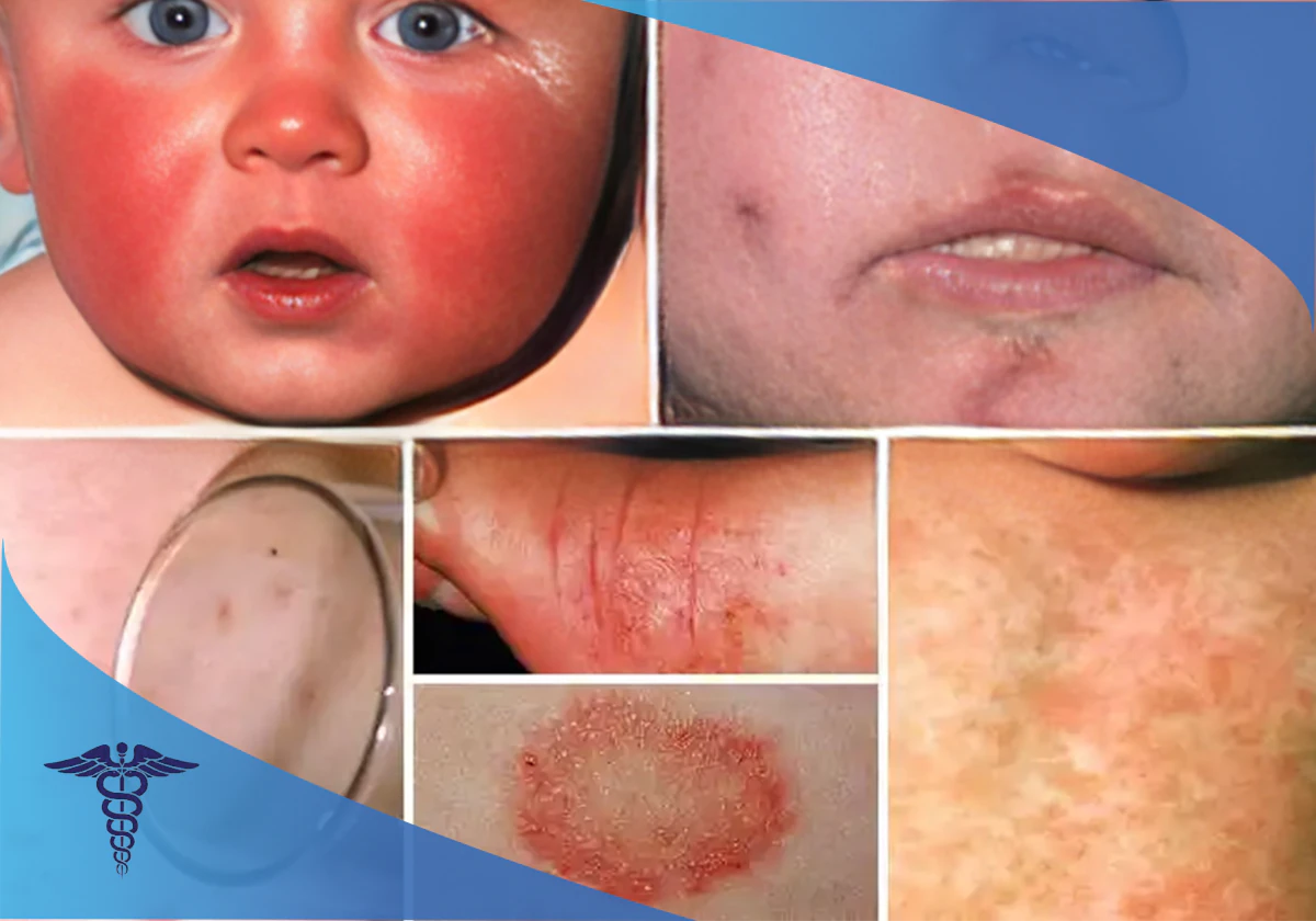 درمان بیماری مننژیت در شیراز؛ روش درمان مننژیت باکتریایی