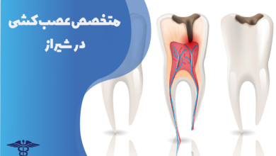 متخصص عصب کشی در شیراز