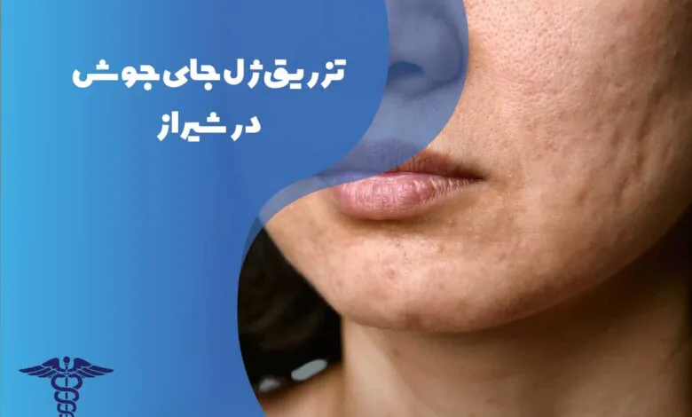 تزریق ژل جای جوش در شیراز