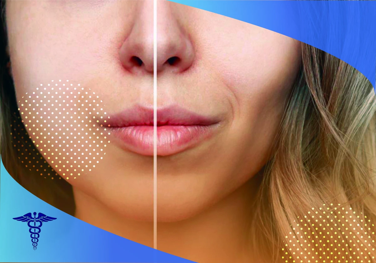 کاندیداهای مناسب برای عمل تخلیه چربی بوکال در شیراز