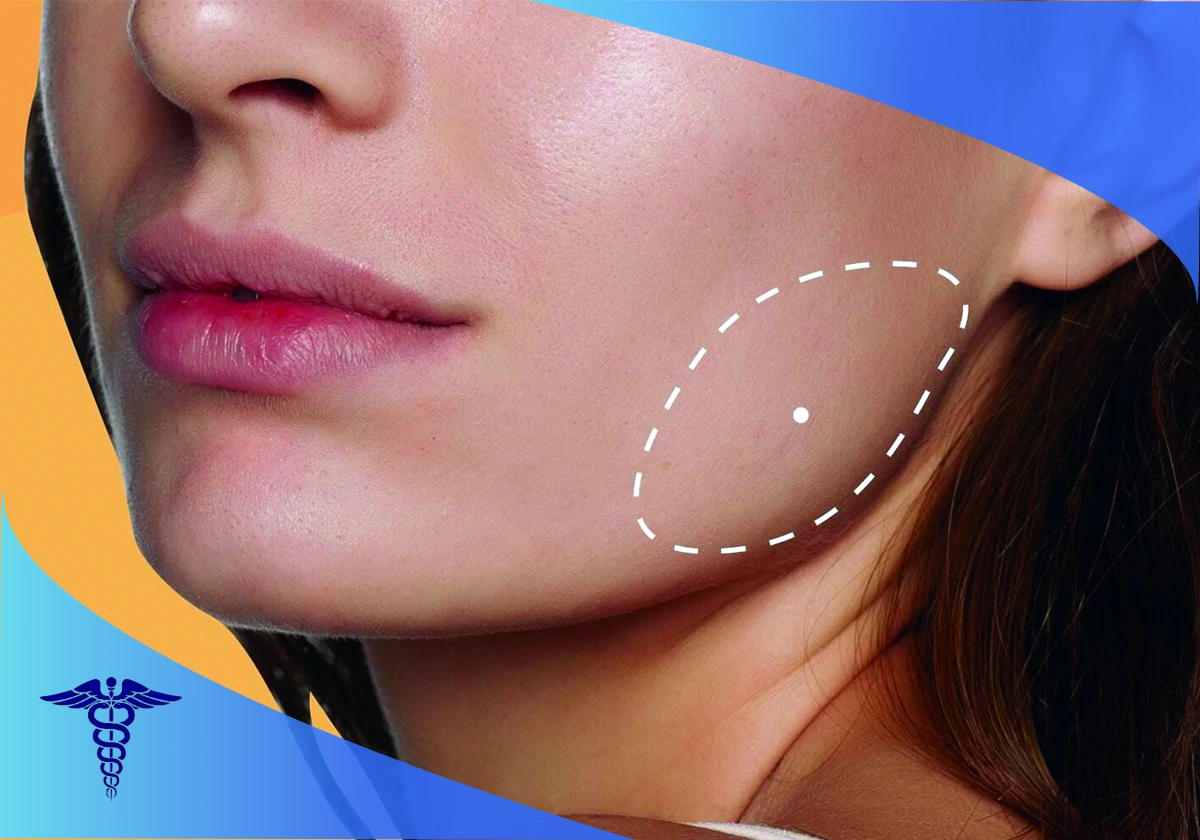 دوره نقاهت عمل زیبایی بوکال فت