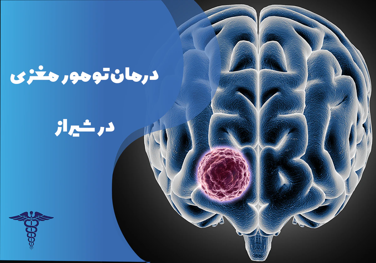 درمان تومور مغزی در شیراز
