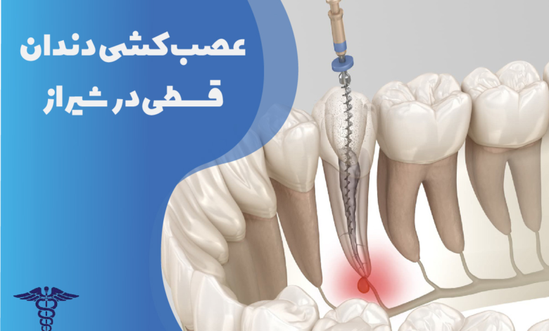 عصب‌کشی دندان قسطی در شیراز