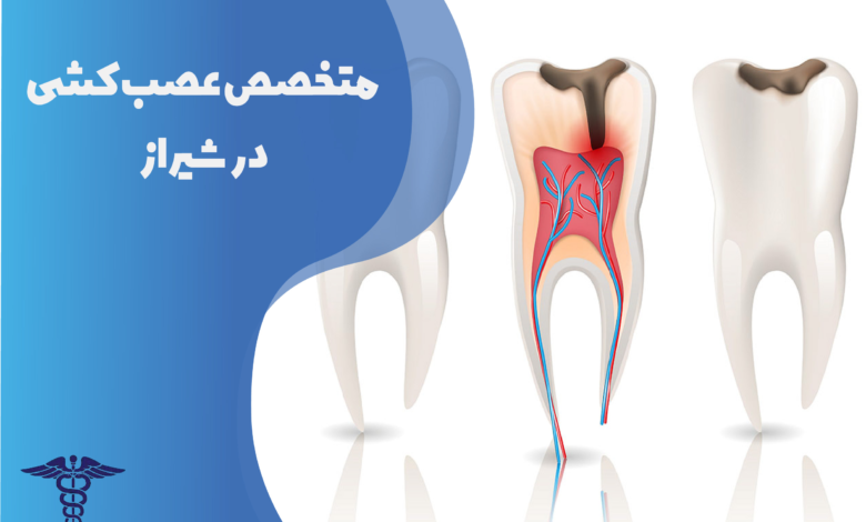 متخصص عصب کشی در شیراز
