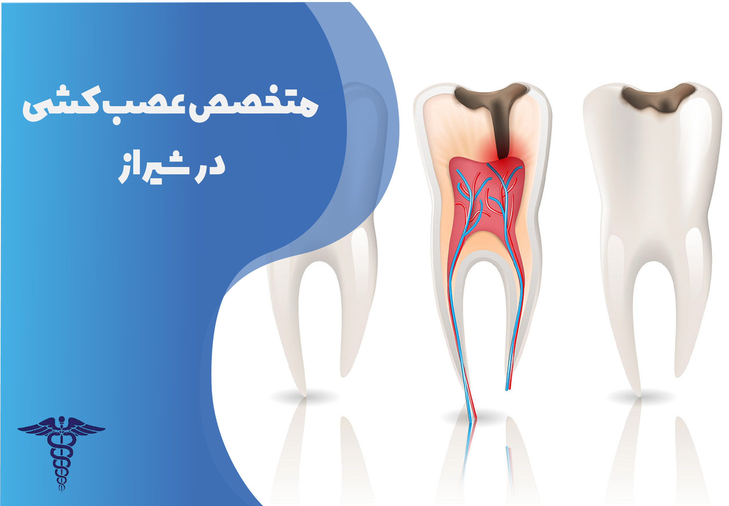 متخصص عصب کشی در شیراز