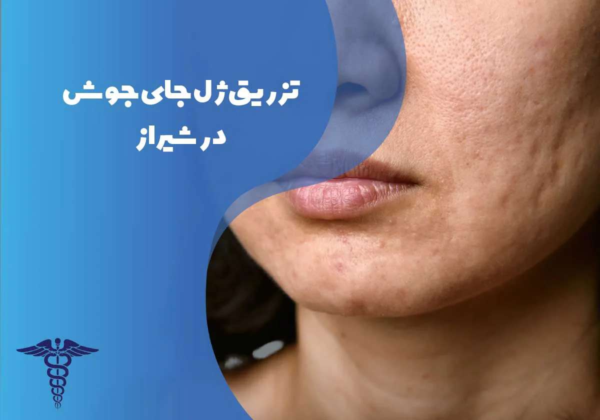 تزریق ژل جای جوش در شیراز