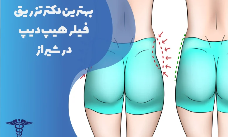 بهترین دکتر تزریق فیلر هیپ‌دیپ در شیراز