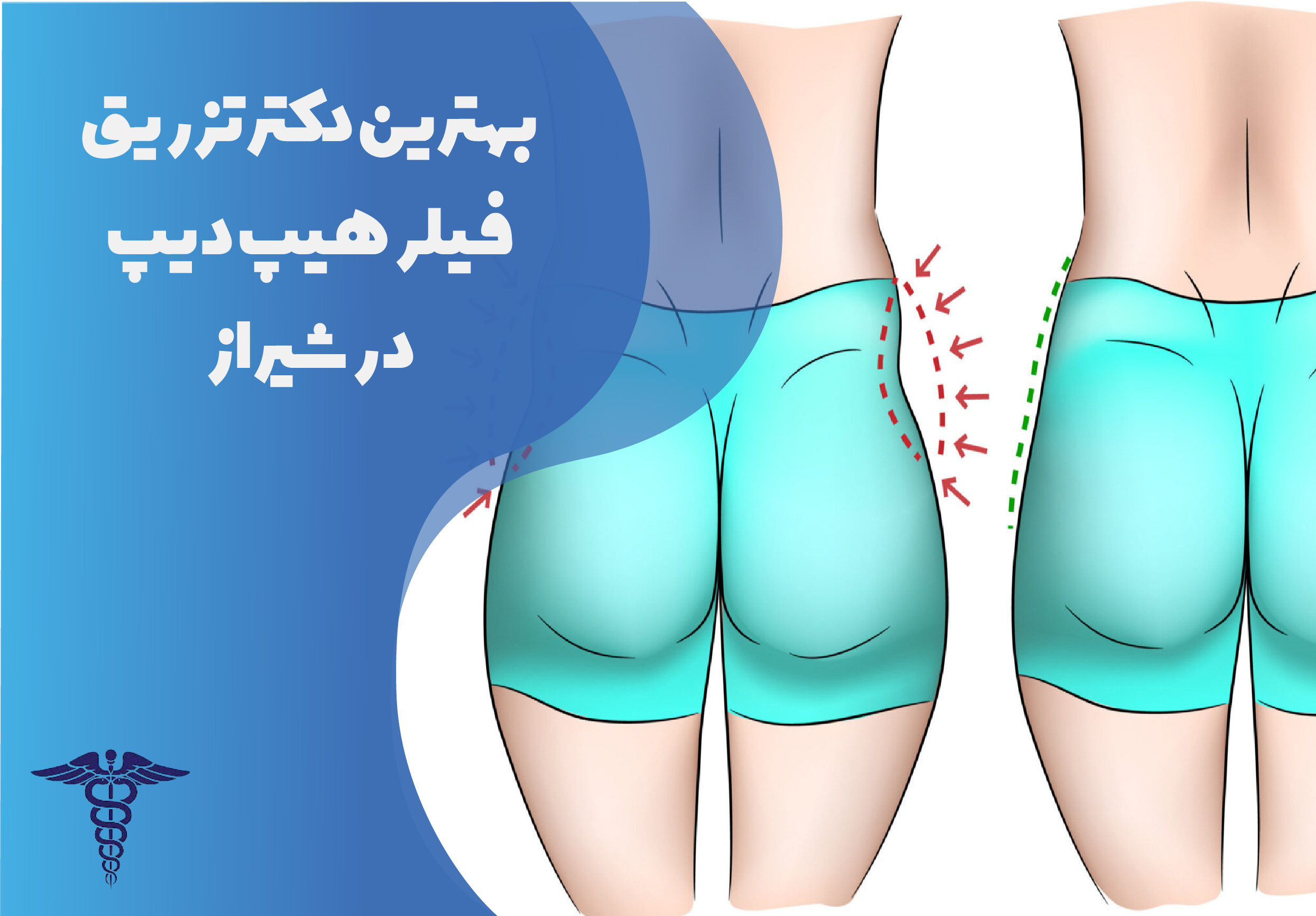 بهترین دکتر تزریق فیلر هیپ‌دیپ در شیراز