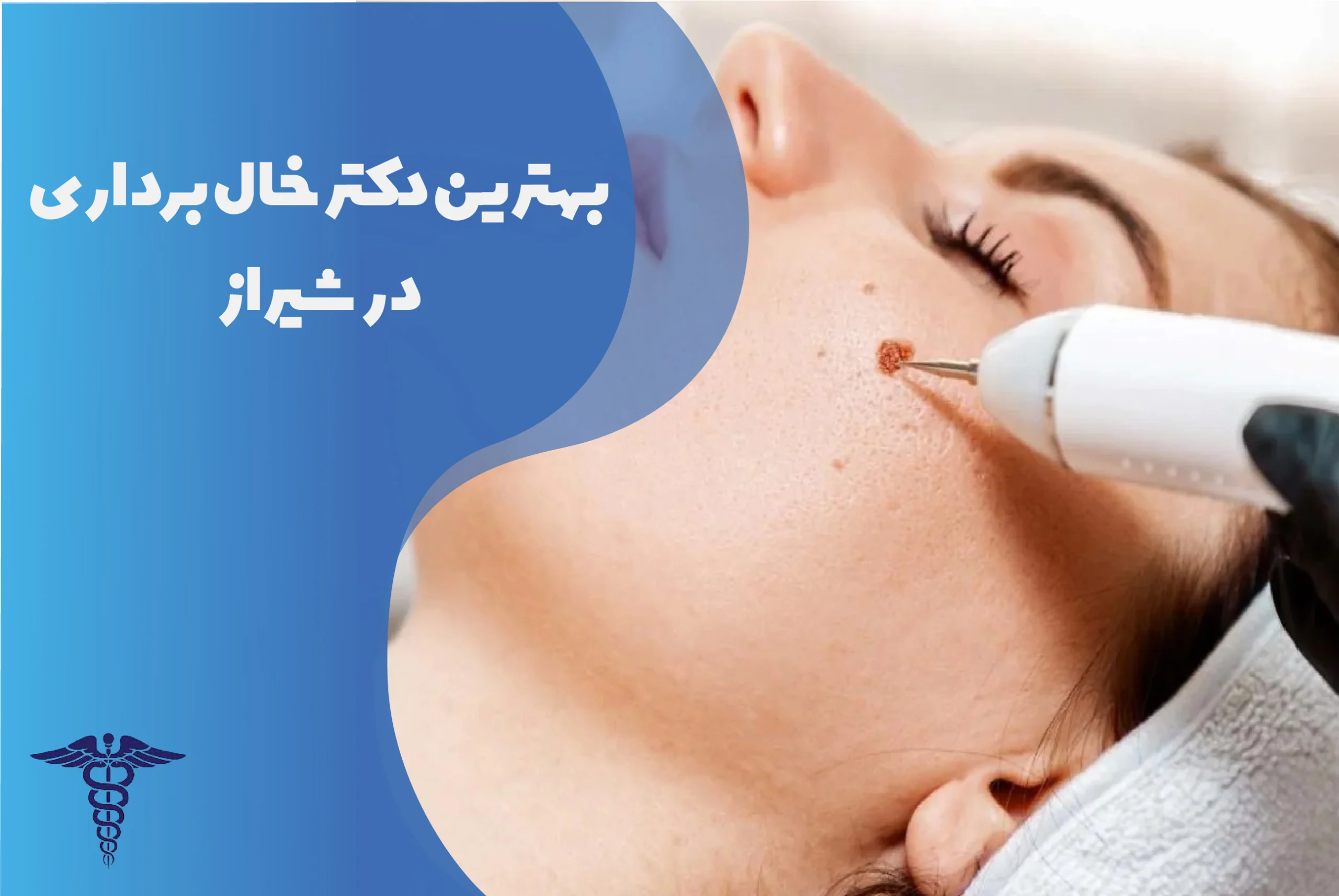 بهترین دکتر خال‌برداری در شیراز