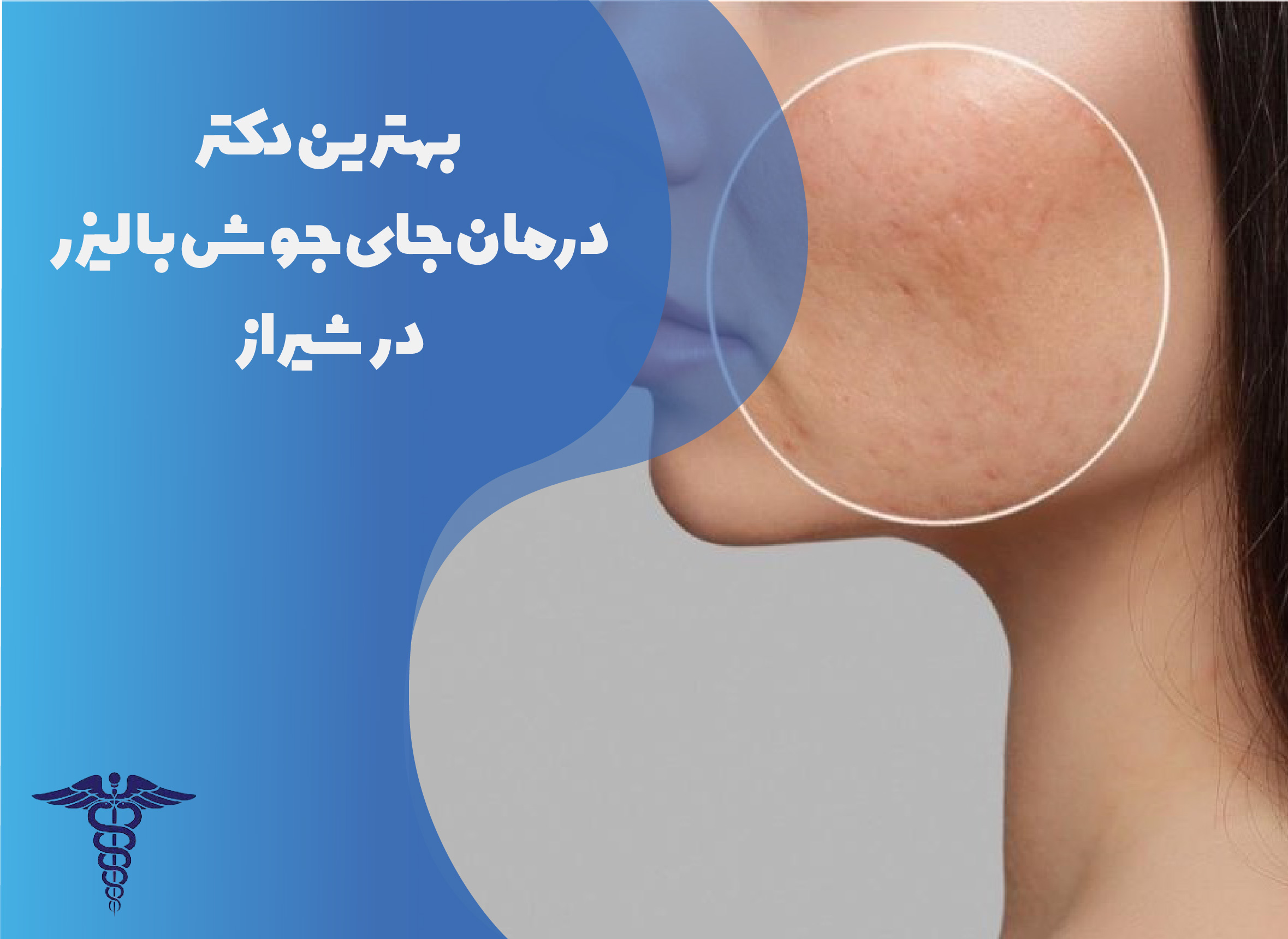 بهترین دکتر درمان جای جوش با لیزر در شیراز