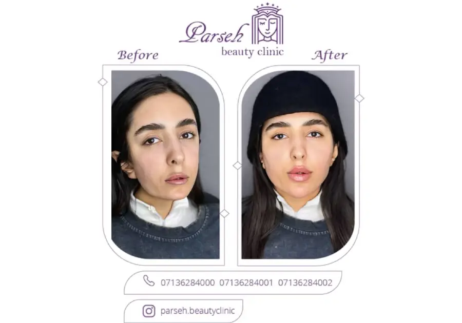 کلینیک پارسه، بهترین کلینیک فیلر فول فیس در شیراز