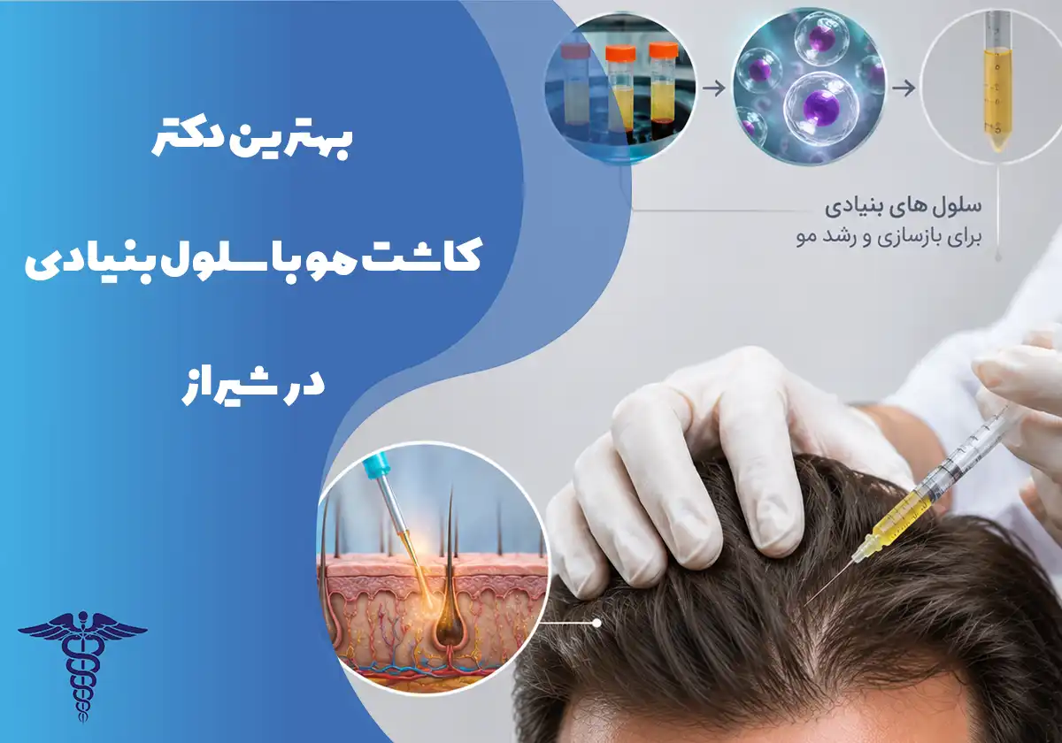 کاشت مو با سلول بنیادی در شیراز + واقعیت طبق منابع پزشکی
